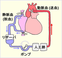 図4. 人工心肺のイラスト