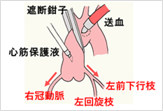 図5. 心停止と心筋保護液のイラスト