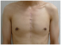 図6. 従来の胸骨正中切開　胸の中央に傷跡がある成人男性の上半身正面の画像