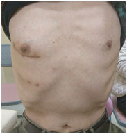 図7. 右肋間小開胸手術<br>の手術創（自験例）　右胸の下部に傷跡がある成人男性の上半身正面の画像