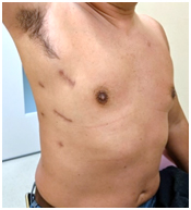 図8. 胸腔鏡下右肋間小開胸手術の手術創（自験例）　右胸の横部分に傷跡がある成人男性の上半身側面の画像