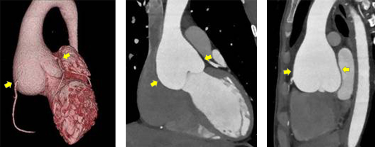 図1． 大動脈基部拡大：バルサルバ洞が洋梨状に拡大していることを示す画像