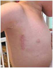 図3. 腋窩切開 子供の上半身右胸横の術後画像