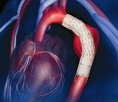 図3. Cook TX2R　胸部大動脈ステントグラフト