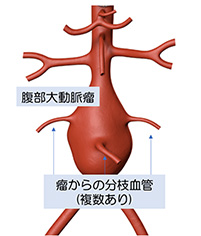 腹部大動脈瘤　瘤からの分枝血管（複数あり）を示すイラスト