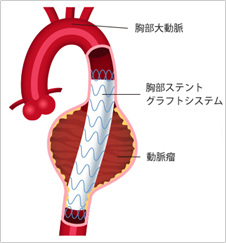 図3. 胸部大動脈ステントグラフト