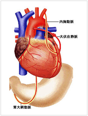 心臓の内胸動脈、胃大網動脈、大伏在静脈の場所を示すイラスト