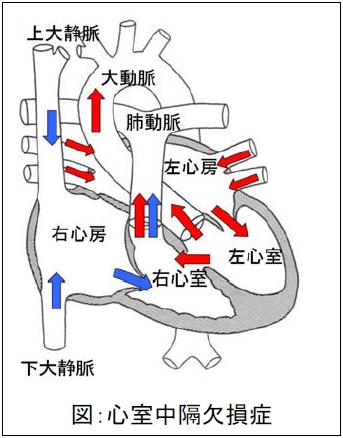 図4．心室中隔欠損症のイラスト