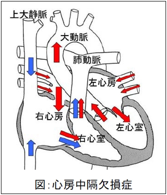 図5.心房中隔欠損症のイラスト