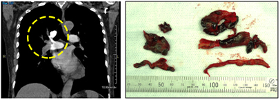 図1．肺動脈に閉塞した血栓像（左）と手術で摘出した血栓（右）（自験例）