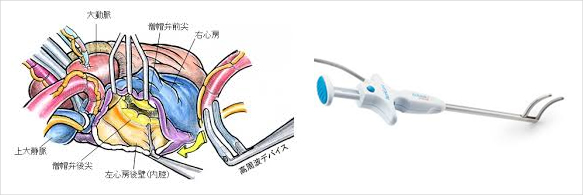 図4. メイズ手術とラジオ波焼灼装置（日本胸部外科学会HPより）