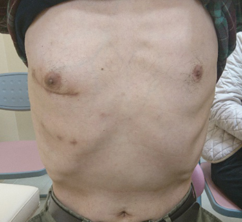 図2．右肋間小開胸（僧帽弁形成術施行）