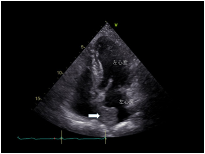図3　心臓エコーで左心房内に腫瘍を認める（矢印）