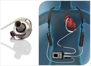 図3. 植込型左心補助人工心臓を装着した状態（メドトロニック、アボット、ニプロより提供）