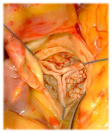 図4．大動脈弁狭窄症：石灰化した大動脈弁（自験例）