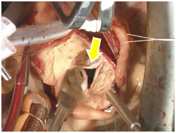 図8．大動脈弁閉鎖不全症：弁尖どうしに隙間（矢印）が開き逆流の原因となっている（自験例）